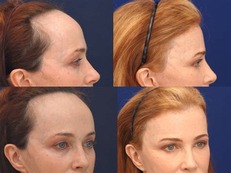 A Plastic Surgeon Who Performs Forehead Reduction Surgeries To Lower