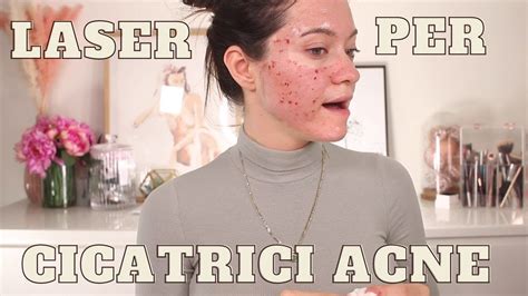 LASER PER CICATRICI ACNE LA MIA ESPERIENZA YouTube