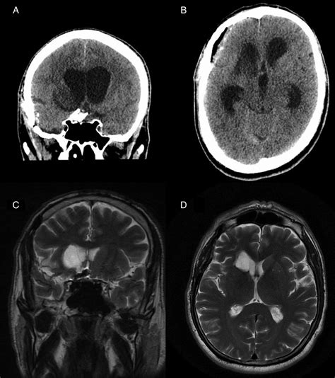 Coronal A And Axial B Ct Demonstrating Right Caudate Nucleus