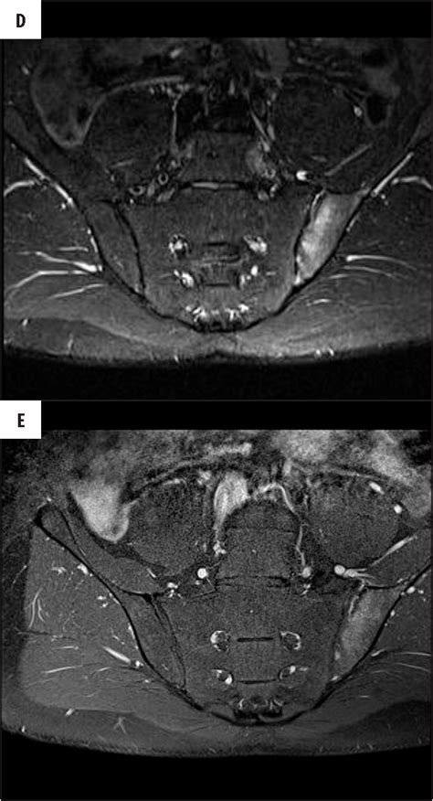 Figure From Diagnostics Of Sacroiliitis According To Asas Criteria A