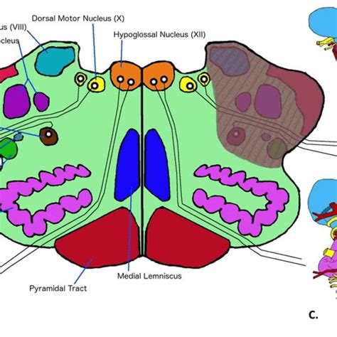 Structures affected in lateral medullary syndrome (A) Transverse view ...