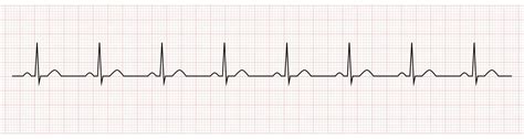 EKG showing normal sinus rhythm of patient 17764767 Vector Art at Vecteezy