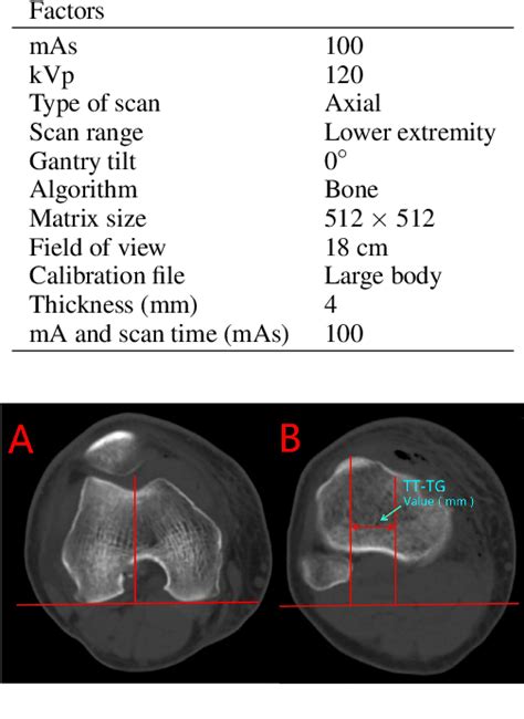 Figure 1 From Comparison Of Tibial Tuberosity Trochlear Groove TT TG