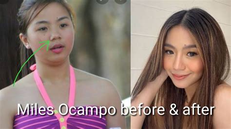 Miles Ocampo Before And After Camille Tan Real Name Nagparetoke Ba Ng