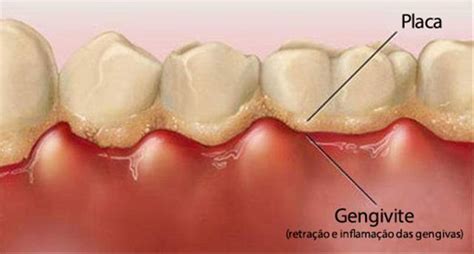 Como Evitar As Cáries Dentárias E Tratar Saúde Blog Opas