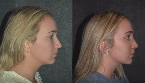 Rhinoplasty Recovery Rhinoplasty Recovery Tips New York