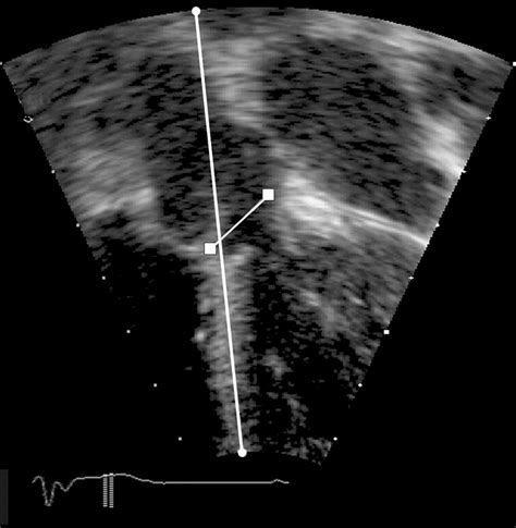 Geometry Of The Left Ventricular Outflow Tract In Fixed Subaortic