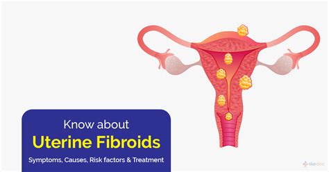 Know About Uterine Fibroids Signs Symptoms Causes Risk Factors And Treatment Skedoc