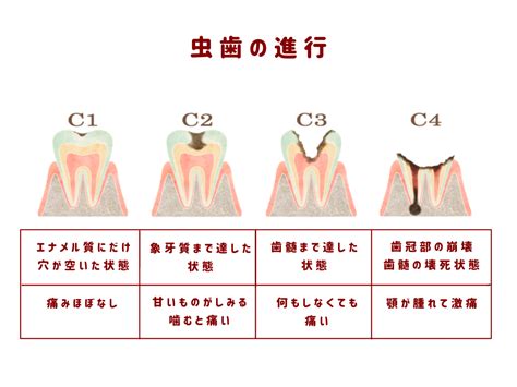 虫歯の原因【2章 2】