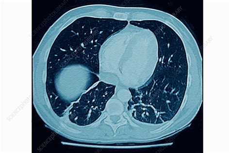 Pulmonary infarction ct scan - Stock Image - C026/9503 - Science Photo ...