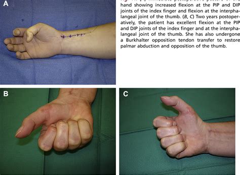 Figure 1 From Tendon Transfers For Radial Median And Ulnar Nerve