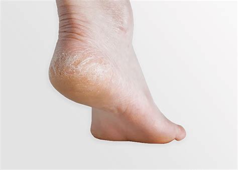 Dry feet causes and treatment - Fastlyheal