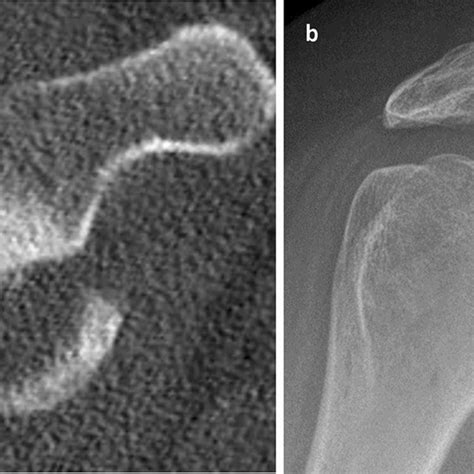 Concentrically reduced humeral head in the A.P.-radiograph is the main... | Download Scientific ...