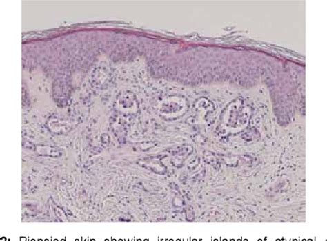 Figure 1 From Zosteriform Cutaneous Metastasis Of Lung Adenocarcinoma Semantic Scholar