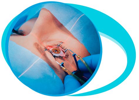 Cataract Surgery In Iran Medpersia Medical Tourism