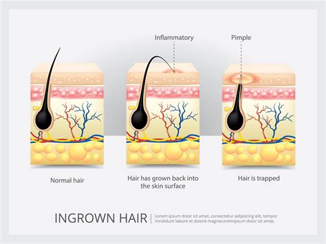 Ingrown Hair Diagram