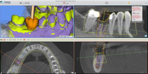 Chirurgia Guidata Senza Boccole Un Caso Clinico Semplice Infodent