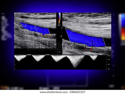 Carotid Artery Doppler Ultrasound Used Check Stock Illustration ...