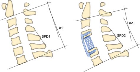 Correction of the cervical curvature. The degree of recovery of ...