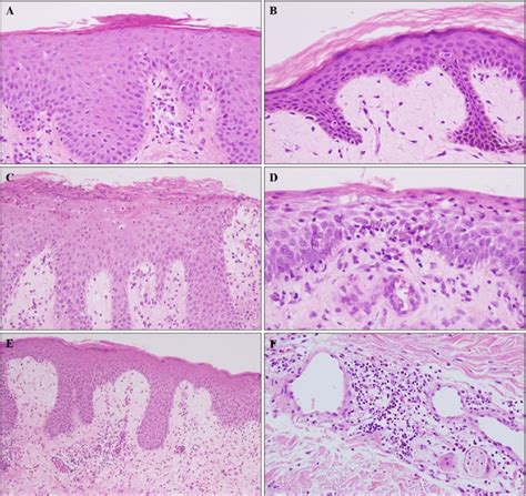 Skin Biopsy Specimens Diagnosed As Tinea Corporis And Tinea Faciei