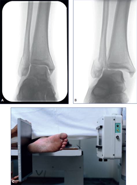 Stress X Ray Ankle