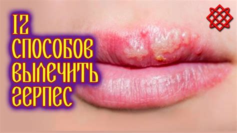 КАК ЛЕЧИТЬ ГЕРПЕС НА ГУБАХ. Как Быстро Избавиться от Герпеса - YouTube