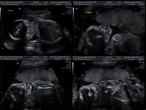 Ultrasound 21 weeks | Baby Steps