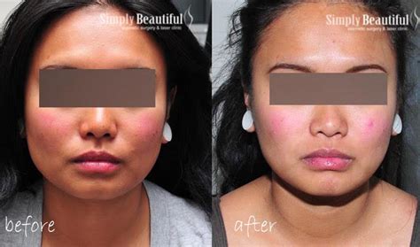 Slim Jawline Injection Dr Peter Kim Cosmetic Laser Clinic