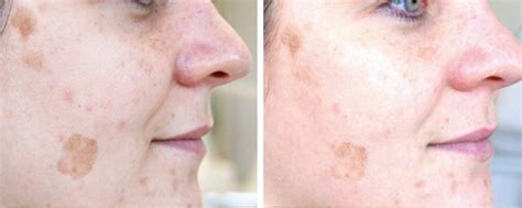 Herbal Green Peel® London Premier Laser Clinic