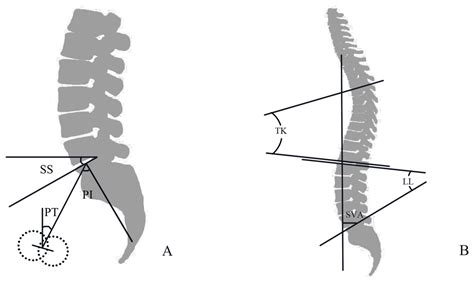 Spinal Pelvic Sagittal Parameters In Patients With Gluteal Muscle