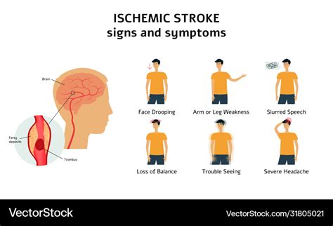 Ischemic stroke signs and symptoms infographic Vector Image