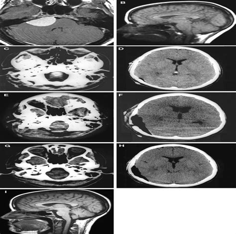 Acute Foramen Magnum Syndrome Caused by an Acquired Chiari M ...