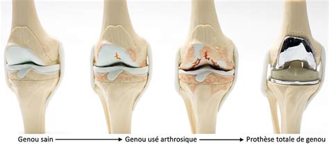 Arthrose De Genou Gonarthrose Dr Simon Tournemine