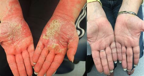 Before After Dermassociates Rockville U S Dermatology Partners