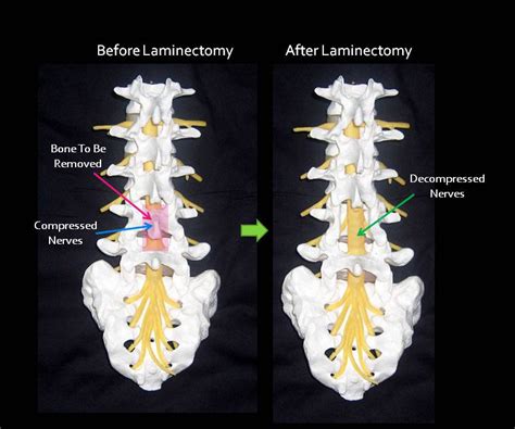 Lumbar Laminectomy - Texas Minimally Invasive Spine Surgery | Dr. Shaad ...