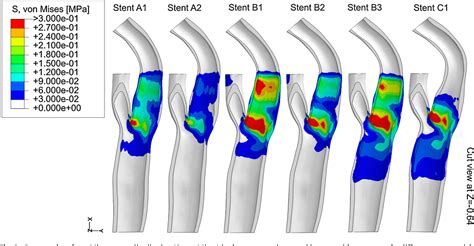 Figure 3 From Carotid Artery Stenting Simulation From Patient Specific Images To Finite Element