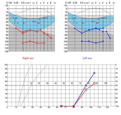 Audiogram