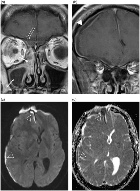 Imaging Review Of The Anterior Skull Base Olivia Francies Levan