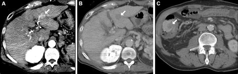 Imaging Findings In Cirrhotic Liver Pearls And Pitfalls For Diagnosis