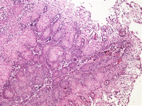 Pathology Outlines Squamous Metaplasia