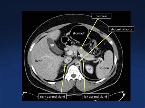 Radiology Imaging Medical Imaging Mri Study Guide Aorta Abdominal