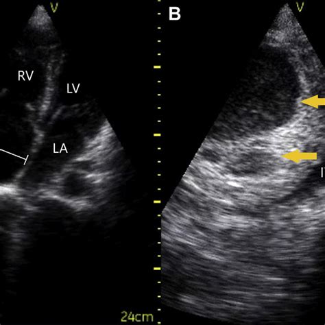 POCUS Findings A Apical Four Chamber View Demonstrates Thickened And