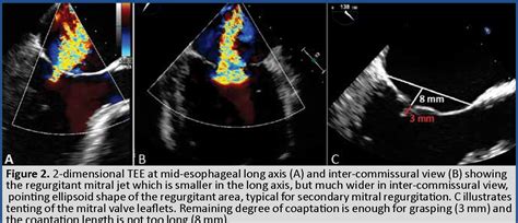 Figure 1 From Percutaneous Repair Of Mitral Regurgitation With The