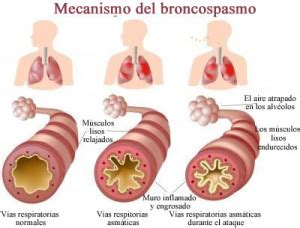 O Q É Broncoespasmo - Broncoespasmo: definición, síntomas, causas y tratamiento | Respiración ...