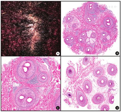 Scarring Alopecia Histology