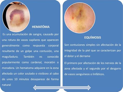 Hematoma Y Equimosis Realizado Por Hernan Campos