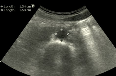 3. Abdominal Aorta Ultrasound Protocol: Short Axis – My Blog