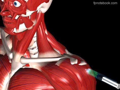 Subacromial Injection Landmarks