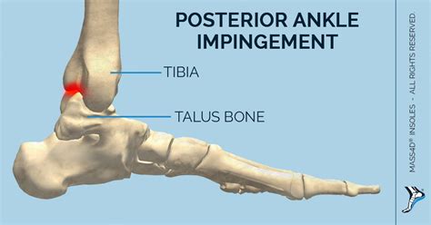 Posterior Ankle Impingement Exercises Exercises For Os Trigonum | atelier-yuwa.ciao.jp