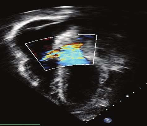 Transthoracic Color Doppler Echocardiography 4 Chamber View Reveals